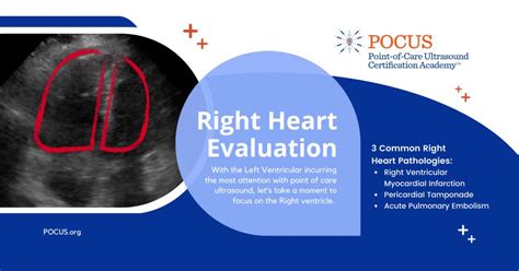 Echocardiography in the Evaluation of the Right Heart.